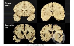 Brain with CTE - chronic traumatic encephalopathy