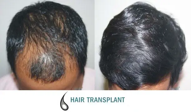 hair transplant